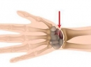 Перелом ладьевидной кости: симптомы и лечение