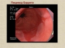 Пищевод Барретта - симптомы заболевания, предшествующего рака пищевода