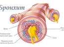 Бронхит