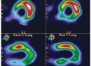 Сцинтиграфия миокарда: описание процедуры, противопоказания и рекомендации