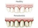 Что такое периодонтит? Классификация и лечение