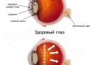 Глаукома - симптомы глаукомы, закрытоугольная и открытоугольная глаукома, диагностика, лечение