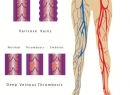 Симптомы тромбоза глубоких вен, которые нужно знать наизусть