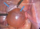 Киста желтого тела - симптомы кисты желтого тела, киста при беременности, основные осложнения, принципы диа