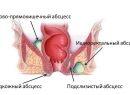 Парапроктит
