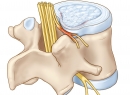 Протрузия дисков поясничного отдела позвоночника