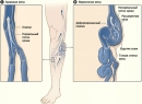 Варикозное расширение вен - симптомы, механизм развития, основные причины развития заболевания, лечение