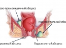 Парапроктит - симптомы гнойного воспаления, его формы и лечение