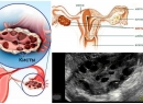 Поликистоз яичников