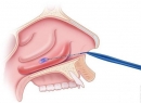 Носовые раковины: болезни и лечение