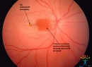 Непроходимость центральной артерии сетчатки