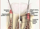 Народные методы лечения пародонтита