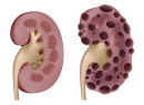 Поликистоз почек Лечение и диагностика