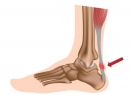 Тендинит ахиллова сухожилия: лечение в домашних условиях