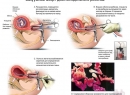 Прерывание беременности хирургическим способом