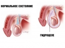 Гидроцеле (водянка яичка)