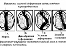 Искривление носовой перегородки - симптомы, вызывающие патологию факторы и причины, формы искривления, с