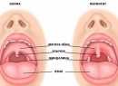 Кашель при фарингите. Чем лечить сухой и влажный кашель? Фарингит у детей: симптомы и лечение