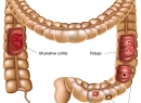 Полипы кишечника