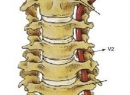 Синдром позвоночной артерии при шейном остеохондрозе: симптомы и лечение
