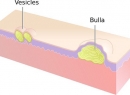 Везикула - это Причины возникновения, симптомы, диагностика, лечение