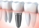Зубная коронка на имплант: тонкости установки