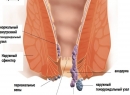 Геморрой - симптомы заболевания, основные признаки и стадии геморроя, внутренний и внешний геморрой, геморр
