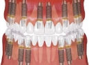 Имплант Osstem. Современное оружие стоматологов