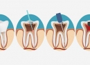 Депульпирование зуба: особенности процедуры, показания