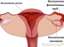 Аднексит - симптомы и лечение хронического и острого воспаления придатков