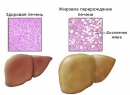 Ожирение печени - симптомы заболевания, особенности течения жирового гепатоза, лечение