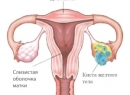 Лечение кисты желтого тела правого и левого яичника: симптомы, причины