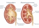 Гидронефроз почки