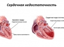 Сердечная недостаточность