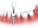 Виды имплантов зубов: описание, плюсы и минусы, фото