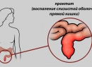 Проктит - воспаление прямой кишки