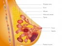Киста молочной железы