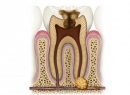 Удаление кисты без удаления зуба: подробности процедуры