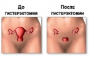 Постгістеректоміческій синдром