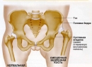 Врожденный вывих бедра