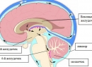 Внутричерепная гипертензия