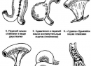 Кишечная непроходимость либо заворот кишок