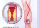 Атеросклероз сосудов нижних конечностей