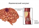 Ишемический инсульт - симптомы, виды и лечение заболевания