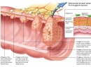 Рак прямой кишки - общая информация