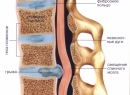 Грыжа позвоночника