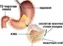 Язва желудка - симптомы и лечение народными средствами