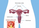 Народные методы лечения ендоцервіциту