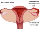 Народные методы лечения эндометрита