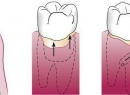 Пародонтальный карман: воспаление и лечение